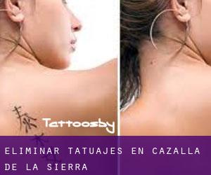 Eliminar tatuajes en Cazalla de la Sierra
