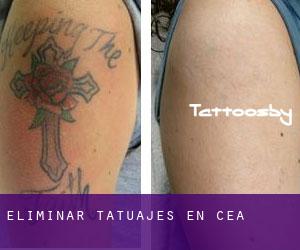 Eliminar tatuajes en Cea