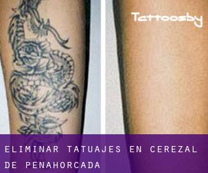 Eliminar tatuajes en Cerezal de Peñahorcada
