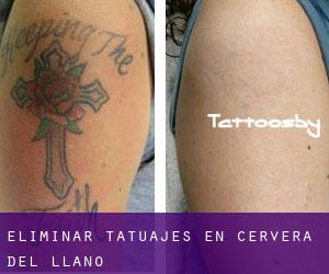 Eliminar tatuajes en Cervera del Llano
