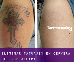 Eliminar tatuajes en Cervera del Río Alhama