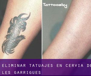 Eliminar tatuajes en Cervià de les Garrigues