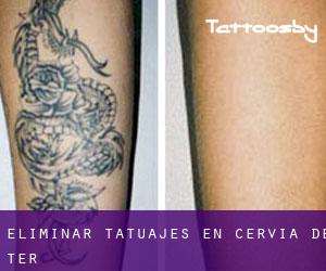 Eliminar tatuajes en Cervià de Ter