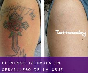 Eliminar tatuajes en Cervillego de la Cruz