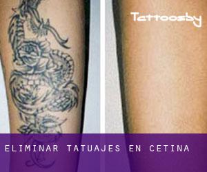 Eliminar tatuajes en Cetina