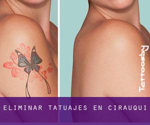 Eliminar tatuajes en Cirauqui