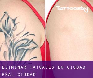 Eliminar tatuajes en Ciudad Real (Ciudad)