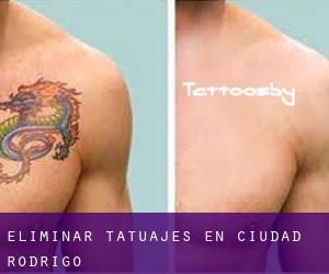 Eliminar tatuajes en Ciudad Rodrigo