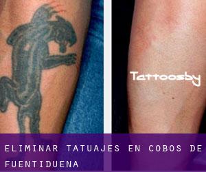 Eliminar tatuajes en Cobos de Fuentidueña
