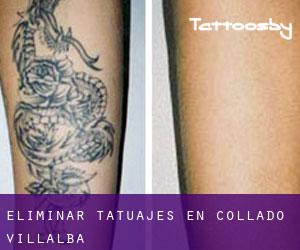 Eliminar tatuajes en Collado-Villalba