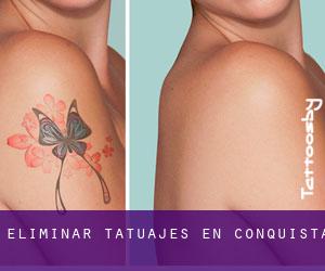 Eliminar tatuajes en Conquista