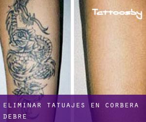 Eliminar tatuajes en Corbera d'Ebre