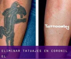 Eliminar tatuajes en Coronil (El)