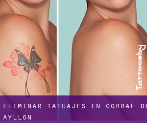 Eliminar tatuajes en Corral de Ayllón