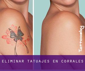Eliminar tatuajes en Corrales