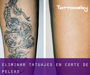 Eliminar tatuajes en Corte de Peleas