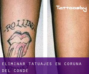 Eliminar tatuajes en Coruña del Conde