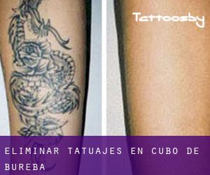 Eliminar tatuajes en Cubo de Bureba