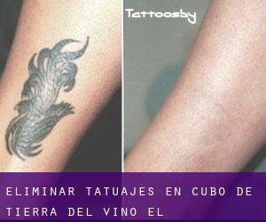 Eliminar tatuajes en Cubo de Tierra del Vino (El)