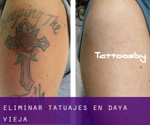 Eliminar tatuajes en Daya Vieja