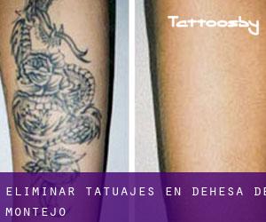 Eliminar tatuajes en Dehesa de Montejo