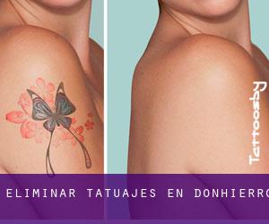 Eliminar tatuajes en Donhierro