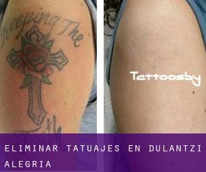 Eliminar tatuajes en Dulantzi / Alegría