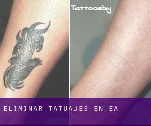 Eliminar tatuajes en Ea