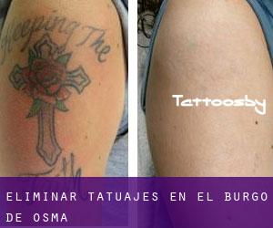 Eliminar tatuajes en El Burgo de Osma