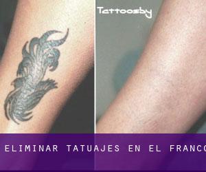 Eliminar tatuajes en El Franco