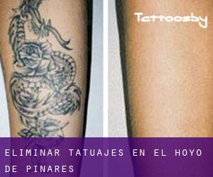 Eliminar tatuajes en El Hoyo de Pinares