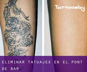 Eliminar tatuajes en el Pont de Bar