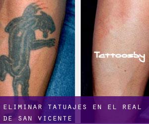 Eliminar tatuajes en El Real de San Vicente