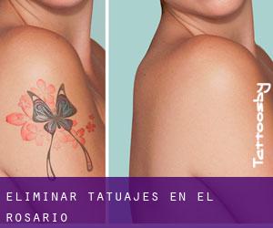 Eliminar tatuajes en El Rosario