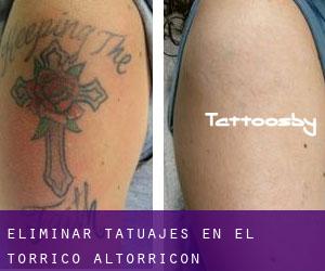 Eliminar tatuajes en el Torricó / Altorricon