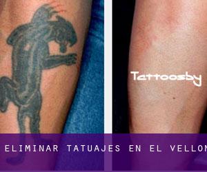 Eliminar tatuajes en El Vellón
