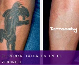 Eliminar tatuajes en El Vendrell