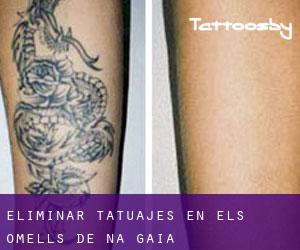 Eliminar tatuajes en els Omells de na Gaia