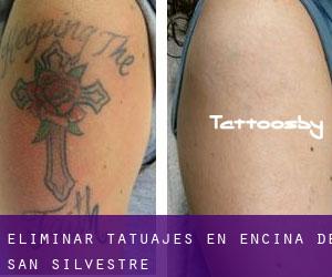 Eliminar tatuajes en Encina de San Silvestre