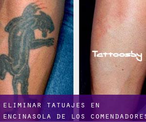 Eliminar tatuajes en Encinasola de los Comendadores