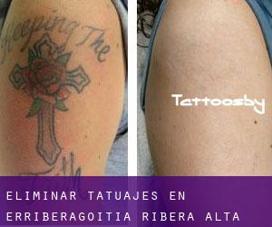 Eliminar tatuajes en Erriberagoitia / Ribera Alta