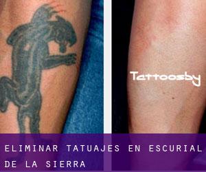 Eliminar tatuajes en Escurial de la Sierra