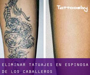 Eliminar tatuajes en Espinosa de los Caballeros