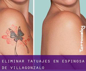 Eliminar tatuajes en Espinosa de Villagonzalo