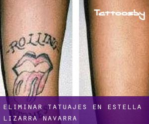 Eliminar tatuajes en Estella / Lizarra (Navarra)