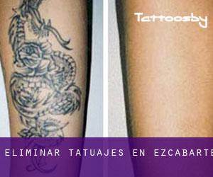 Eliminar tatuajes en Ezcabarte
