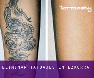 Eliminar tatuajes en Ezkurra