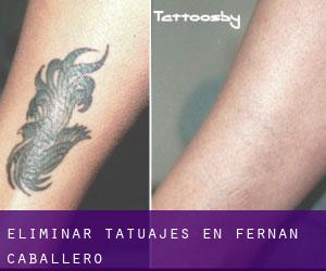 Eliminar tatuajes en Fernán Caballero