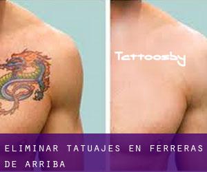 Eliminar tatuajes en Ferreras de Arriba