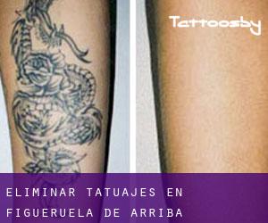 Eliminar tatuajes en Figueruela de Arriba